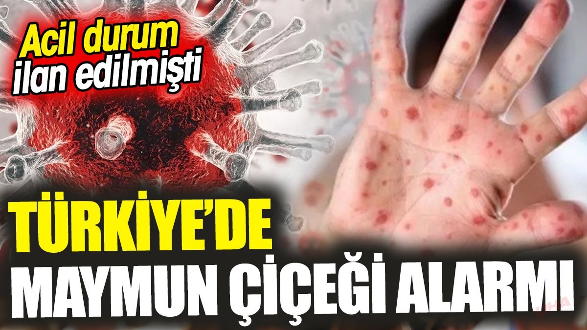 Türkiye’de maymun çiçeği alarmı ‘Acil durum ilan edilmişti